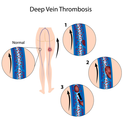 Deep Vein Thrombosis, DVT, spinal cord injury complications