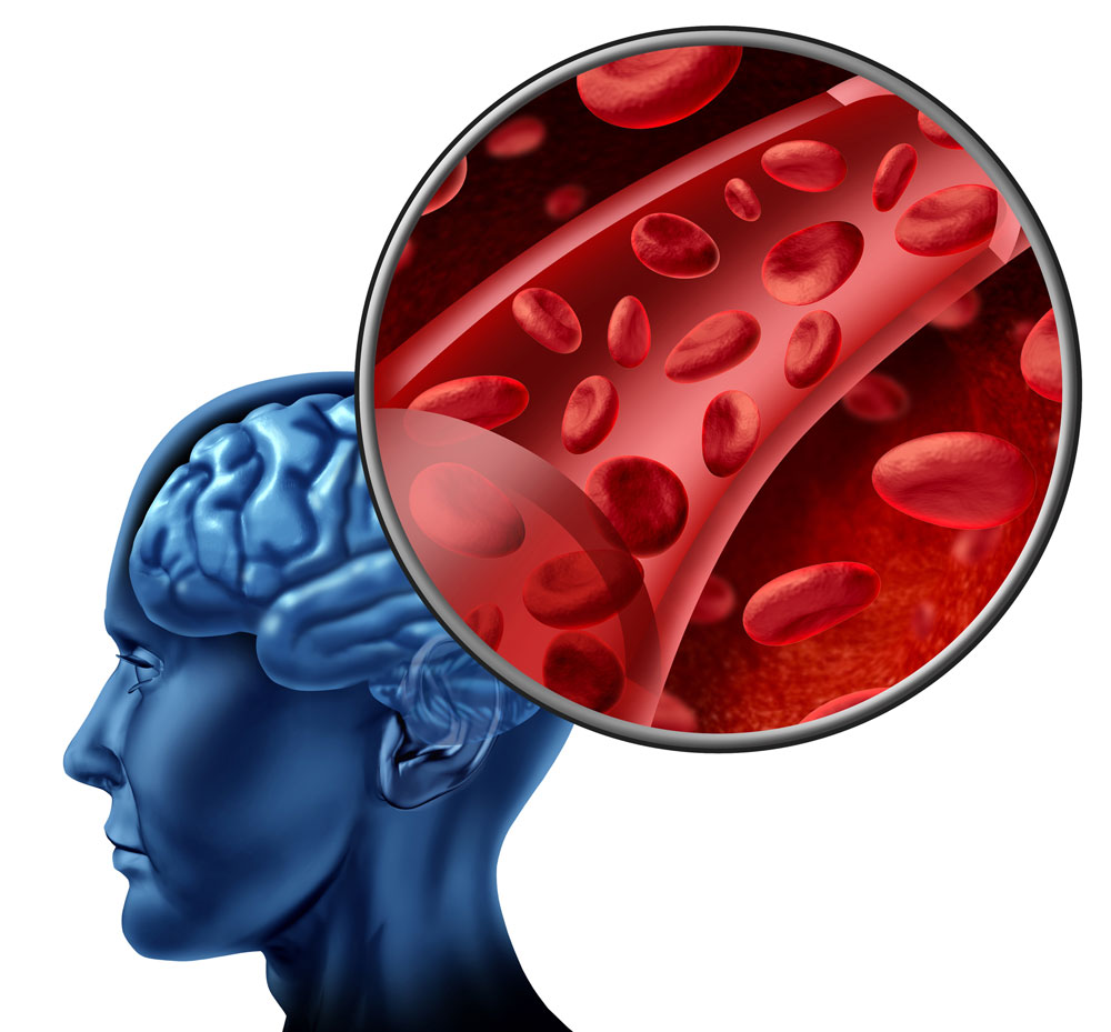 stroke rehab